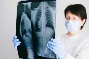 A doctor reviews X-rays from a patient with COPD who needs to receive social security disability benefits.